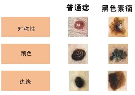 屁股長黑痣|這是痣，還是黑色素癌？醫師：這種斑最危險！